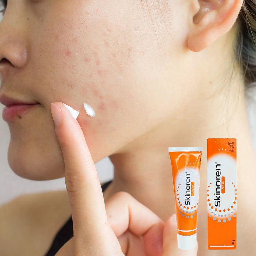 ✨ Skinoren Acne Cream 20% – Clear Skin & Spot Removal 💖