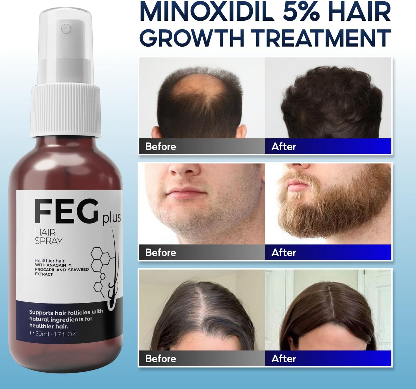 FEGPLUS Minoxidil Hair & Beard Growth Serum (50ml), Rosemary Oil for Hair Growth Booster